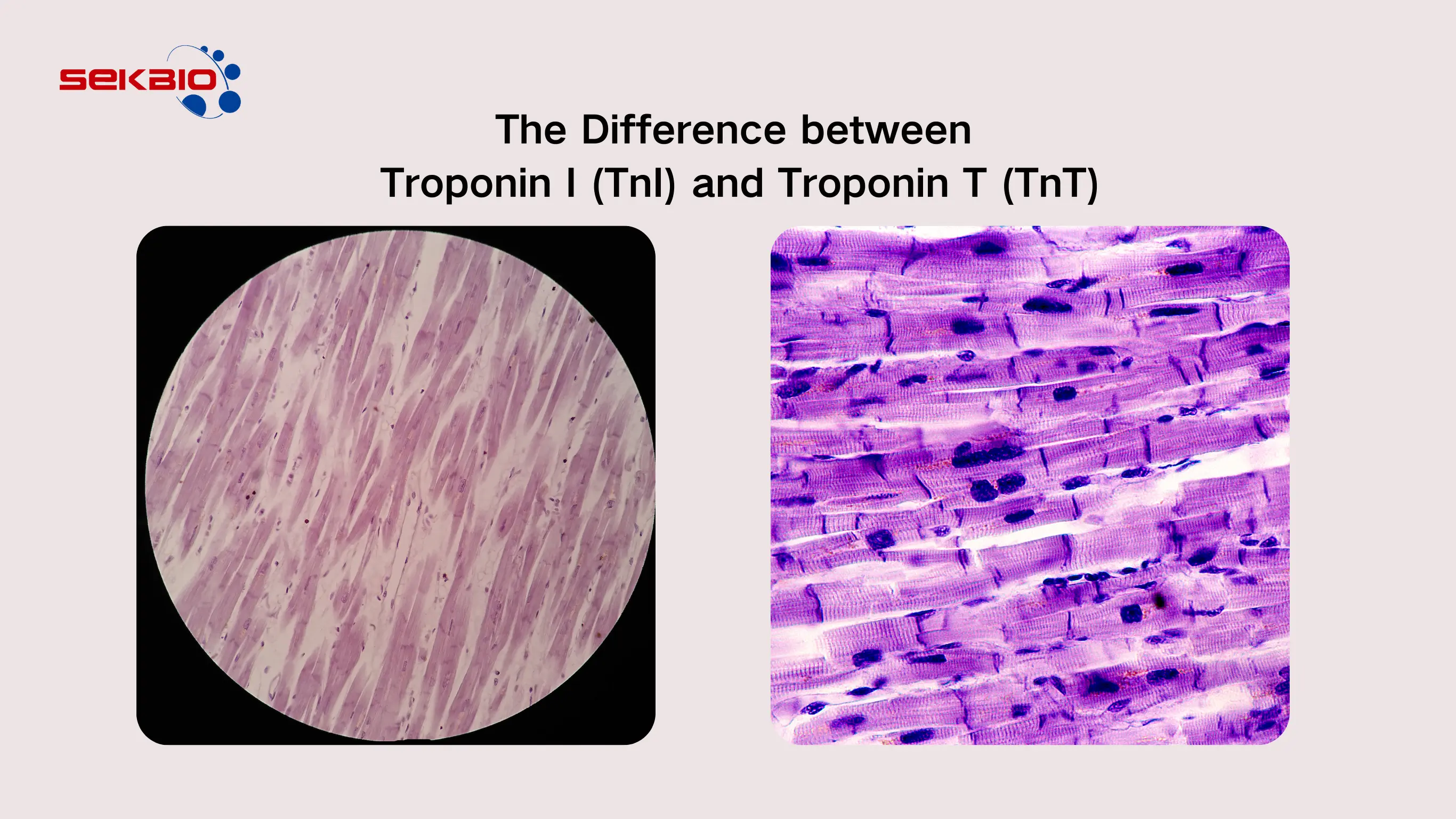 The Difference between Troponin I (TnI) and Troponin T (TnT)